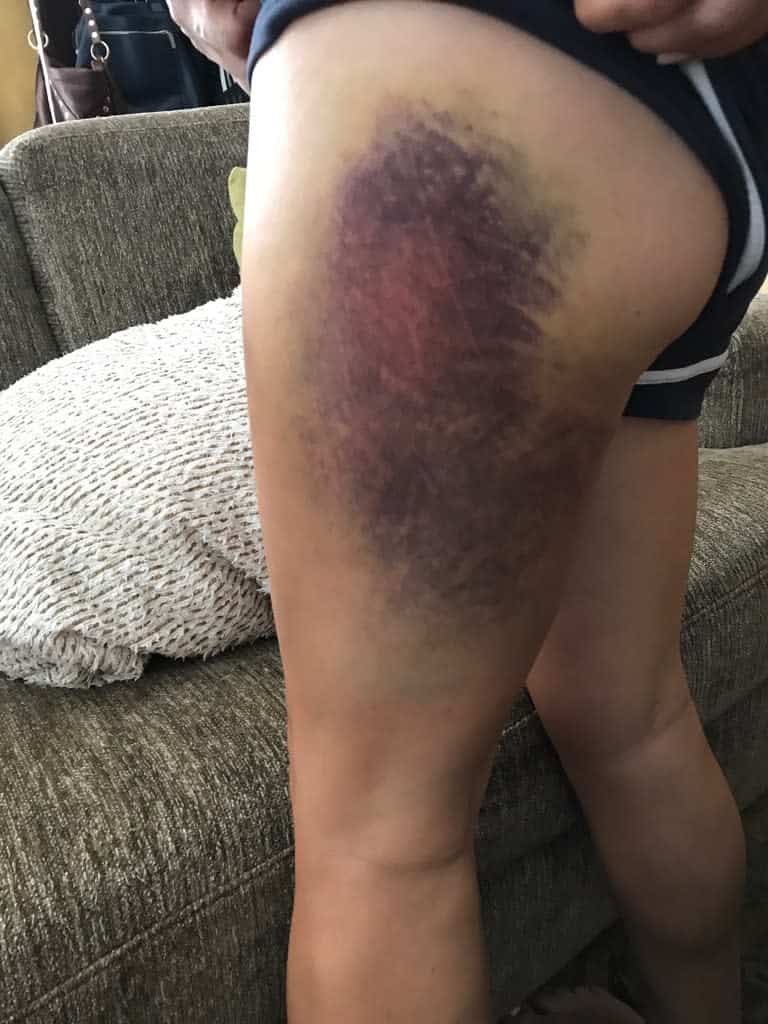 $250K por un Accidente en un Parque Acuático