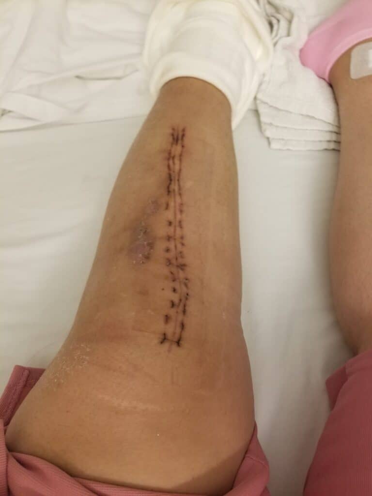 $1M Negociados por Lesiones Causadas por Negligencia del Propietario