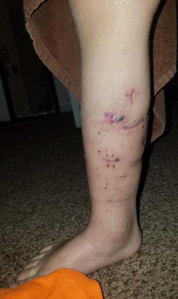 $500K Settlement Awarded for a Dog Attack